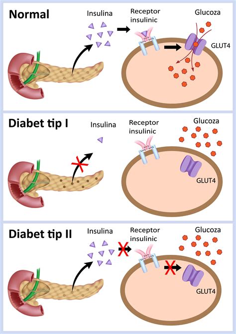 Diabetul de tip 1 și tipul 2 care sunt diferențele